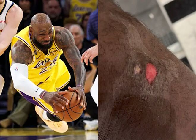 勒布朗·詹姆斯腿部受伤调侃救球结束 东契奇当